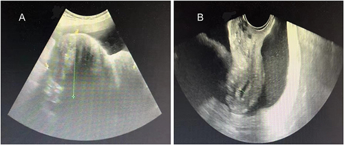 Figure 1 (A) Combined transvaginal and transabdominal ultrasonogram showing a large irregular mass (13.1 cm × 8.2 cm) with hypoechoic features in the left side of the pelvic cavity; (B) Transvaginal ultrasonogram showing massive ascites in the abdominopelvic cavity.