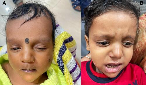 Figure 3 Characteristic facies of Alagille syndrome. (A) In an infant with cholestasis of 2 months age. (B) In a 2-year-old child with Alagille syndrome.