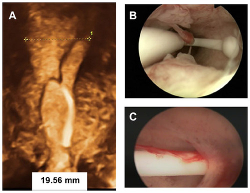 Figure 2 Examples of incompatibility between the intrauterine device and the uterine cavity.