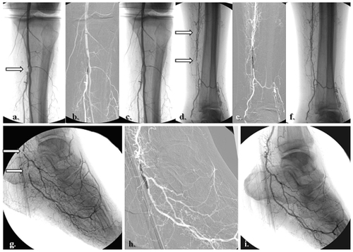 Figure 2 Selective revascularization of the posterior tibial and lateral plantar artery angiosome: (a–f) Staged angioplasties in the posterior tibial artery. (g–i) Selective angioplasties in the lateral plantar artery and its appended angiosome.