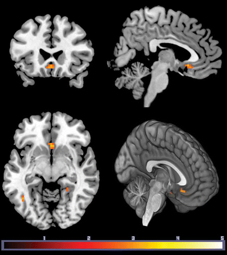 Figure 1. Subgenual cingulate cortex activation for affiliative versus non-affiliative stimuli was associated with stronger perception of one’s family as a distinct group (entitativity). Results are displayed at p < .005 uncorrected, k = 10. Effects in the SGC survived FWE corrected over an a priori ROI (p = .04; 10 mm ROI). Color bar indicates t value.