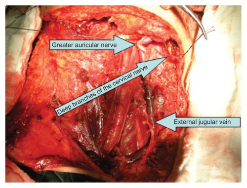 Figure 3 The patient was treated with NRND after the accessory nerve was dissected.