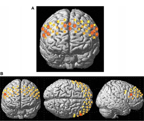 Figure 2 Localization matrices mapped over a standard brain template. Areas shown in yellow represent matrix of guidance channels. (A) Matrix of guidance in which areas shown in orange represent regions of interest. (B) Patients with obsessive-compulsive disorder had significantly smaller changes in oxygenated hemoglobin concentration than controls at channel 18 (orange), localized near the right lateral prefrontal region.