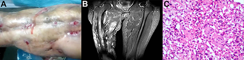 Figure 1 Three images of the affected area in case 1. (A), Features of osteomyelitis caused by Nocardia otitidiscaviarum; (B), Magnetic resonance imaging manifestation of chronic osteomyelitis; (C), Pathological examination of septic changes under a 10*20x microscope.