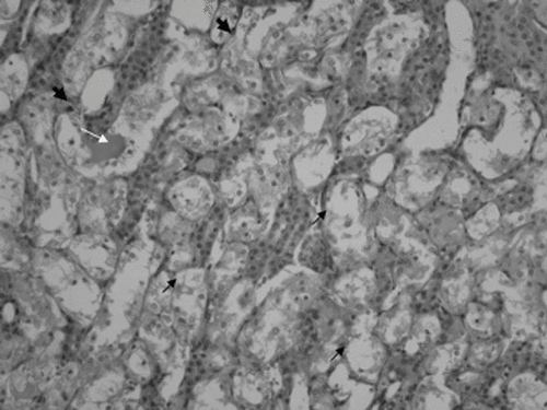 Figure 1. Epithelial necrosis (short black arrow), cast formation, (long white arrow), and apoptotic cells (arrowhead) in the distal tubulus due to cisplatin nephrotoxicity (×200 HE; cisplatin group).