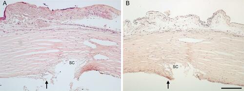 Figure 7 The anterior chamber angle following KDB Glide goniotomy showing near-complete excision of TM overlying the Canal of Schlemm (SC) in both (A and B) with minimal leaflet tissue remnants (ranging from 0 to 50 µm, arrows). H&E stained sections, scale bar = 200 µm.