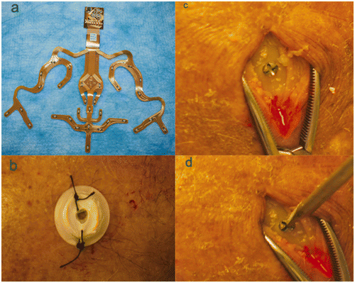 Figure 1. The three different registration modes used in the study: (a) the auto-registration mask; (b) scalp fiducials; and (c) bone fiducials. In (d) the pointer is seen touching one of the external targets.