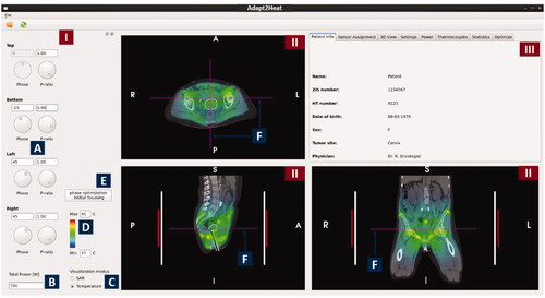 Figure 3. Screenshot of the graphical user interface of Adapt2Heat. A control panel (I) allows for phase-amplitude selection, power adjustment, scaling, switch between SAR and temperature visualization and initial phase optimization (A-E). Predicted distributions are instantly updated and projected onto the CT scan in the visualization windows (II). The selected orthogonal slices are indicated by dotted lines in each cross section (F). In the tabbed window (III), specific functionality can be selected by clicking the individual tabs, as explained in the text.