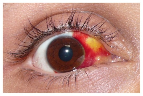 Figure 4 An island of yellow discoloration on the nasal part of the bulbar conjunctiva indicating absorption of the subconjunctival hemorrhage.