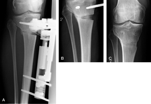 Figure 2. Hemicallotasis osteotomy using the Orthofix T-garche as external fixator. A. Successive lengthening takes place. The HKA angle is slowly normalized and the frame is locked at the desired angle. The frame is kept until bone healing. B. When sufficient callus appears to be present by ultrasound and radiography, the frame is removed temporarily. The patient is allowed to bear weight before the final decision to remove the frame. This decision is made blind regarding the pharmacological treatment. C. Radiograph showing a healed osteotomy at 1.5 years.