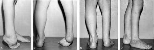Figure 6. Six-year old boy (same as seen in Figure 5) with residual deformities (equinus, cavus, adductus). A–B: before treatment with Ilizarov External Fixator. C–D: at follow-up. Lehman Foot score: Fair.