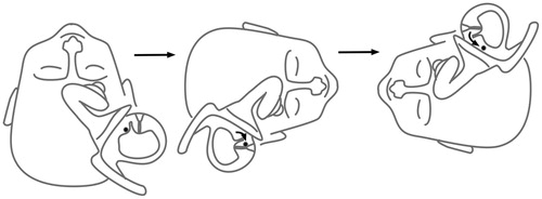 Figure 2. Horizontal short arm canalolithiasis causing unilateral crescendo–decrescendo apogeotropic horizontal nystagmus when the involved ear is lowermost.