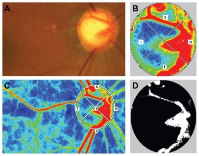 Figure 2 Color map and binary image of laser speckle flow graph in a patient with the generalized enlargement disc type of glaucoma. (A) Fundus photograph of the left optic disc in a patient with the generalized enlargement disc type of glaucoma (64-year-old female, baseline intraocular pressure 17 mmHg, Humphrey field analyzer mean deviation −8.01 dB). (B) Color map image of the optic nerve head. (C) Color map image of the whole area and the optic nerve head depicted by region of interest. (D) Binary map of the optic nerve head. The white area indicates the vessel, and the black area indicates tissue.