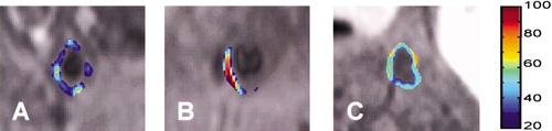 Figure 4. A magnetic resonance imaging(MRI) application at 1.5 T using αvβ3‐integrin‐targeted, paramagnetic perfluorocarbon nanoparticles in a hyperlipidaemic rabbits to detect angiogenesis within the aortic wall. Per cent enhancement maps (false‐coloured from blue to red) are illustrated from individual aortic segments at renal artery (A), mid‐aorta (B), and diaphragm (C) 2 hours after infusion of the αvβ3‐integrin‐targeted nanoparticles. (With permission from Winter et al. 2003 Citation45.)
