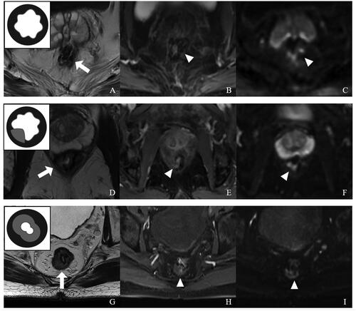 Figure 1. Representative images for distinct anastomotic fibrosis score (AFS) values with a schematic diagram (top left corner) based on postoperative rectal MRI. (A–C) AFS = 0. (A) T2WI showing a low-signal intensity anastomosis around the rectal wall without fibrosis (arrow), Covered by normal mucosa. (B) In CE-T1WI, no obvious abnormal enhancement was found at the anastomotic site (arrowhead). (C) DWI (b = 1000 s/mm2) showing a low-signal anastomosis with partially high-signal intensity susceptibility artifacts (arrowhead). (D–F) AFS = 1. (D) In T2WI, the anastomosis had some thickened fibrotic tissue at the right posterior rectal wall (<1/3 circle, arrow). (E) CE-T1WI showing homogeneous enhancement from mild to moderate at the partially thickening anastomotic site (arrowhead). (F) DWI (b = 1000 s/mm2) showing a low-signal anastomosis with partially high-signal intensity susceptibility artifacts (arrowhead). (G–I) AFS = 2. (G) T2WI showing a full-circle thick layer of homogeneous intermediate-low signal intensity (>2/3 circle, arrow), with anastomotic stenosis. (H) CE-T1WI showing mild to moderate enhanced proliferation tissue at the anastomotic site (arrowhead). (I) DWI (b = 1000 s/mm2) showing partially high-signal intensity susceptibility artifacts (arrowhead).