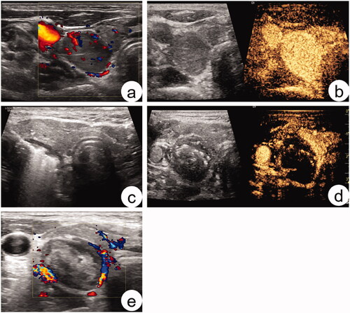 Figure 2. Sonogram of parathyroid adenoma before and after MWA. A 56-year-old woman was diagnosed with a parathyroid adenoma by ultrasound-guided biopsy before ablation. (a) Sonogram of parathyroid adenoma before MWA: the adenoma was hypoechoic, with a regular shape and clear boundary. Color Doppler flow imaging reveals a slightly rich-colored blood flow in the interior and edge; (b) Before MWA, the adenoma showed uniform and high enhancement in contrast-enhanced ultrasound (CEUS); (c) During ablation. (d) After ablation, there was almost no enhancement in CEUS. (e) One month after MWA, no obvious blood flow was found in the tumor.