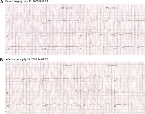 Figure 5 ECG changes of acute inferior wall myocardial infarction post-operation.