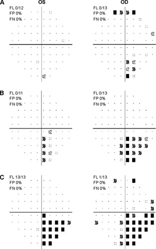 Figure 1 Humphrey visual field stimulus III 24-2 pattern deviation plots for case 1.
