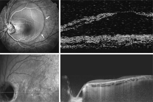 Figure 2 Optic disc pit in a male patient.