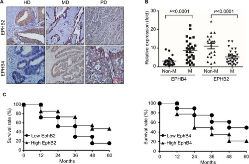 Figure 2 EPHB2 and EPHB4 indicate opposite prognosis.Note: (A) Immunohistochemistry staining of EPHB2 and EPHB4 expressions in the representative HD CRC, MD CRC, and CRC. Magnification, 200×. (B) Relative mRNA levels of EPHB2 and EPHB4 in metastasis group (M) and non-metastasis group (Non-M) via qRT-PCR. (C) Kaplan–Meier assay showed the survival analyses of CRC patients based on EPHB2 or EPHB4 expression. High EPHB2 or EPHB4 represents patients with individual expression of EPHB2 or EPHB4 ≥ cutoff, and low EPHB2 or EPHB4 represents patients with individual expression < cutoff.Abbreviations: CRC, colorectal cancer; HD, high differentiation; PD, poor differentiation; MD, medium differentiation.