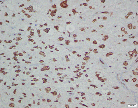 Figure 3 Immunohistochemistry staining for ATRX+ (patient with glioblastoma).