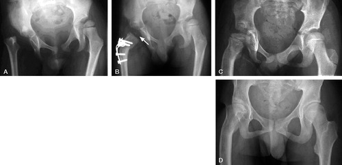 Figure 3. Patient no 3. A. Preoperatively, showing a totally luxated hip. B. 18 months after arthroplasty, the osteotomy had been fixated with a plate. The arrow points to a tiny ossification center in the new femoral head. C. 6 years after arthroplasty. Note the growth plate below the transposed greater trochanter. D. 6 years postoperatively. The new head is nearly spherical and well covered by a congruent acetabular roof.