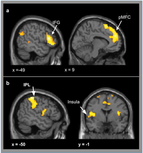 Figure 3. A shows activation for conflict vs no-conflict trials. When participants were presented with conflict conditions, we observed greater bilateral activation in posterior medial frontal cortex (pMFC), inferior frontal gyrus (IFG) and left dorsal ACC compared to no-conflict versus conflict conditions. B shows activation for no-conflict vs conflict trials. Compared to conflict trials, no-conflict trials lead to stronger activation in the insula, bilaterally, the left posterior cingulate cortex (PCC), left parietal lobe (IPL) and precentral regions. Results were cluster level corrected (p < 0.05, voxel-level uncorrected p < 0.001, cluster level corrected at pFWE < 0.05).