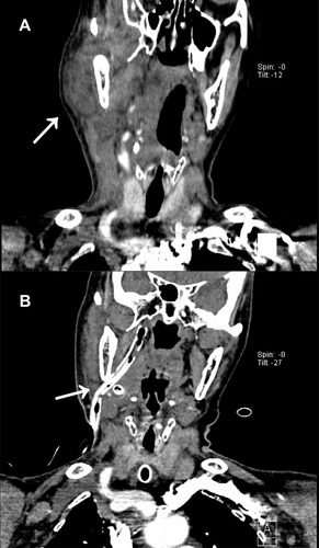 Figure 6 Contrast-enhanced CT scan of a patient treated with the MIVD device. (A) Preoperative contrast-enhanced CT scan of the patient. Abscess cavities can be seen (A, the white arrow). (B) The contrast-enhanced CT scan on the seventh day after the surgery. Abscess cavities were effectively eliminated. The MIVD device extended well in the abscess cavity beneath the skull base (B, the white arrow).