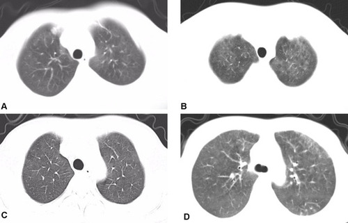 Figure 1 Representative CT images from four patients during the initial phase of PJP, all showing ground-glass opacities in the apexes of both lungs. (A) PJP occurred 10 months after renal transplantation (RT) in a 35-year-old male recipient. CT showed ground-glass opacities in the apexes of both lungs. (B) PJP occurred 10 months after RT in a 47-year-old male recipient. CT showed a decrease in the transmittance of the two lungs, and diffuse ground-glass opacities in the apexes. (C) PJP occurred 13 months after RT in a 40-year-old male recipient. CT showed ground-glass opacities in the apexes of both lungs. (D) PJP occurred 1 month after anti-rejection treatment (14 months after RT) in a 43-year-old female recipient. CT showed increased clouding and ground-glass opacities in the apexes, and the edges were unclear.