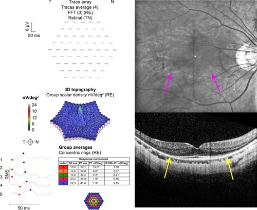 Figure 4 Monochromatic fundus photography, multifocal electroretinography (mfERG), and spectral domain optical coherence tomography (SD-OCT).