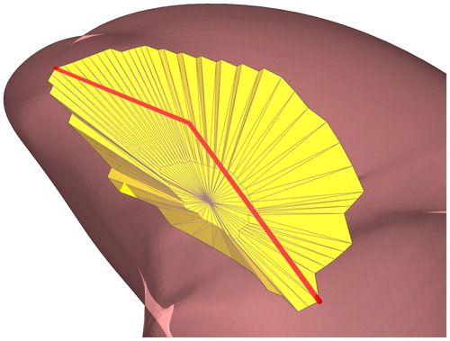 Figure 4. A visual representation of the selected resection volume. The yellow volume is the volume that is about to be removed. The red line indicates over which line the future resection will be closed.