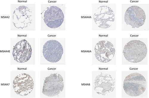Figure 5. Immunohistochemistry pictures from HPA display the protein expression levels of MS4A family in lung cancer.