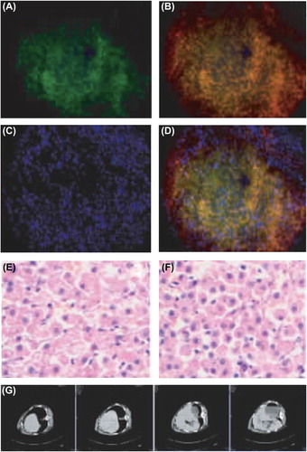 Figure 4. Liver morphology after transplantation. (A) Expression of GFP gene in cells under the fluorescent microscope (× 20); (B) abundant insulin expression in the cytoplasm of the same region (× 20); (C) cell nuclear staining (× 20); (D) merged image (× 20); (E) results of HE staining of normal liver tissue section (× 40); (F) results of HE staining of liver after transplantation (× 40); (G) CT scanning results (tumors were not detected).