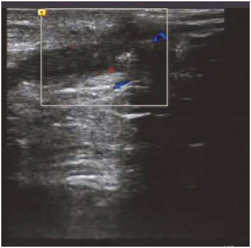 Figure 2. B-Mode Ultrasound Image of case 2 (a).