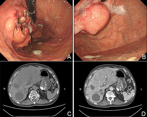 Figure 1 Gastroscopy and abdominal CT images of this patient. (A and B) Gastroscopy showed the tumor protruded from the gastric cavity with superficial ulceration; (C and D) Abdominal CT and contrast-enhanced CT revealed multiple liver hypodensity nodules.