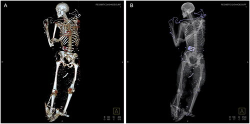 Figure 3. Postmortem CT-scan of victim: penetrated foreign objects (shrapnel) and partial avulsion underlegs. (A) Three-dimensional image of total skeleton. (B) Conventional radiologic overview of total body.
