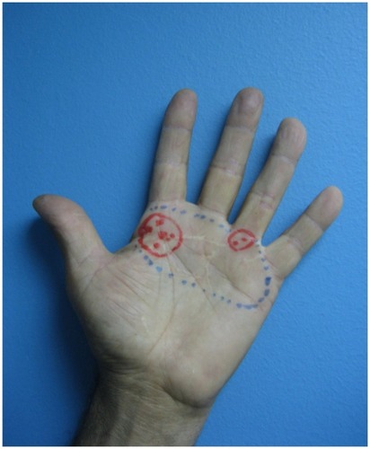 Figure 3 Painful surface area before (blue area) and after (red areas) treatment with 5% lidocaine medicated plaster (LMP).