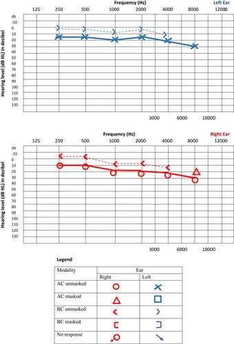 Figure 1 Pure tone audiometry.Notes: Right: SRT, 15 db; MCL, 50 db; In quiet lebel, 100. Left: SRT, 15 db; MCL, 50db; In quiet level, 100.Abbreviations: RE, right ear; LE, left ear; dB, decibel; SRT, speech recognition threshold; MCL, most comfortable level; AC, air conduction; BC, bone conduction.