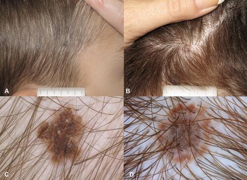 Figure 6 Scalp nevi in children. (A and B) brown pigmented macule on hair bearing scalp. (C) Regular globular pattern. (D) Targetoid pattern in a compound nevus.
