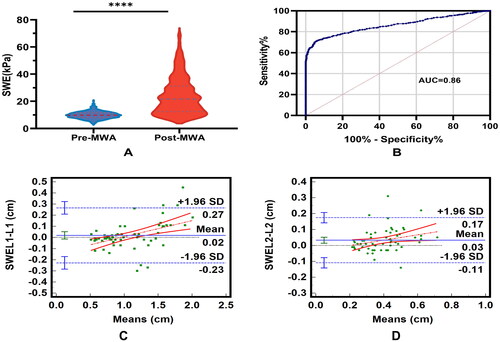 Figure 4. SWE-value and measurements of the ex vivo porcine brain ablation areas.Note: A: Comparison SWE-value of pre-MWA and post-MWA by Mann-Whitney U test (****, P < 0.001). B: Receiver operating characteristic curves demonstrate ability to use SWE to identify ablation area after MWA. AUC, area under receiver operating characteristic curve = 0.86; C,D. Bland-Altman analysis were used to compare the consistency of SWE and pathological specimens in measuring the maximum diameter of ablation area.