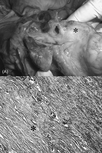 Figure 1. (A) The section through the left atrium with masses of fibrous tissue (asterisk), which compressed the large veins. (B) Almost acellular masses of the fibrous tissue 1.2 cm thick (asterisk) surrounding the lamina muscularis of the vena cava superior.