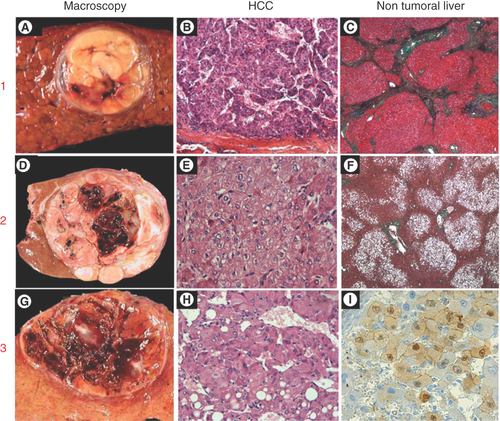 Figure 1. Morphological patterns of hepatocellular carcinomas in patients with metabolic syndrome/NAFLD.1. HCC arising in a patient with cirrhosis (A) well-limited encapsulated nodule of 3 cm within a cirrhotic liver; (B) Moderately differentiated HCC (hematein & eosin staining); (C) Nontumoral liver showing cirrhotic nodules (trichrome staining). 2. HCC arising in a patient without advanced chronic liver disease (D) well-limited nodule of 6 cm; (E) Well-differentiated HCC (hematein and eosin staining); (F) Nontumoral liver showing normal architecture with steatosis (trichrome staining). 3. HCC arising in a pre-existing hepatocellular adenoma (G) well-limited nodule of 4 cm showing hemorrhagic areas in a background normal liver, (H) Well-differentiated HCC (hematein & eosin staining); (I) β-catenin immunostaining showing nuclear positivity of tumoral hepatocytes from the hepatocellular adenoma component.HCC: Hepatocellular carcinoma; NAFLD: Non-alcoholic fatty liver disease.