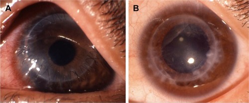 Figure 1 Postoperative appearance of a 32-year-old DALK/KC female patient (case #10).