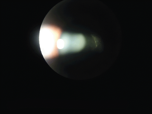 FIGURE 1  Anterior Segment Biomicroscopy - Cells and Flare.