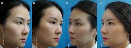 Figure 4 Treatment of mid-face volume loss with hyperdiluted RAD.