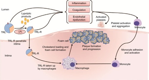Figure 2 Proposed pathophysiology of triglyceride-rich lipoproteins in the progression of atherosclerosis.