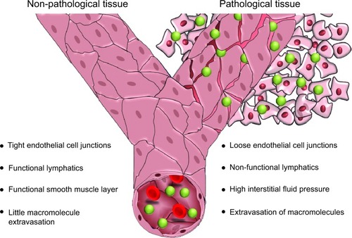 Figure 1 Enhanced permeability and retention effect results from loose endothelial junctions allowing extravasation of macromolecules and nonfunctional lymphatics, resulting in prolonged retention of macromolecules within the pathological tissue, in this representation tumor tissue. This tissue also shows a high interstitial fluid pressure and a lack of a functional smooth muscle layer surrounding the blood vessels.