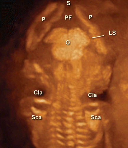 Figure 11.  3D maximum mode image of occipital view at 13 weeks of gestation. Note the premature occipital bone appearance. Midline crack is demonstrated. S; Sagittal suture, P; Parietal bone, PF; Posterior fontanelle, O; Occipital bone, Cla; Clavicular, Sca; Scapula, LS; Lambdoid suture.