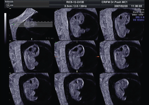 Figure 13.  Tomographic sagittal imaging of normal fetus at the beginning of 8 weeks of gestation.