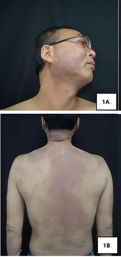 Figure 1 Clinical presentations at admission. (A and B) Hypertrophic dark red plaques were seen in the head-face-neck area and torso, which had partially merged together.